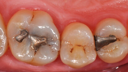 Nuovo metodo per restauro in composito diretto nei settori latero-posteriori