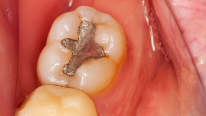 Three African countries to phase down dental amalgam use