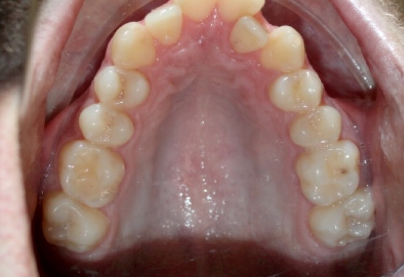 Fig. 13: Narrow maxilla.