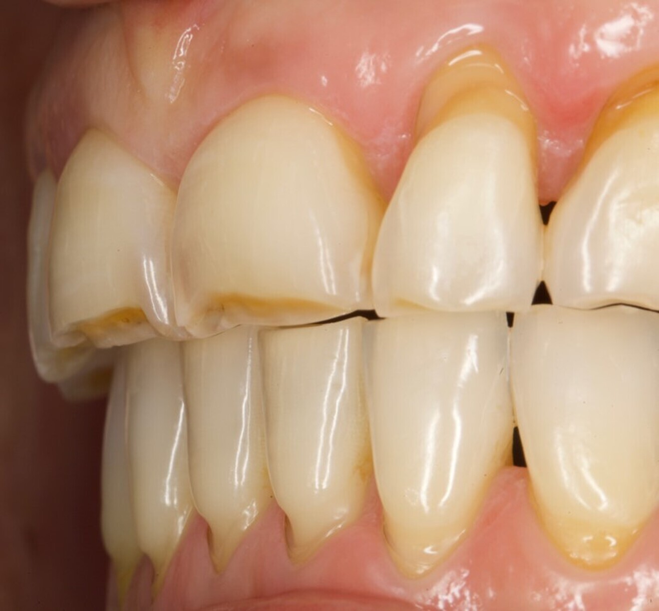 Fig. 2: Close-up of the severely worn central incisors.