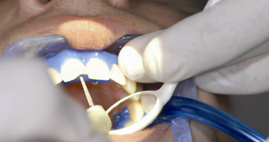 Preparazione di incisivo centrale con Laser Erbium Litetouch (Syneron)