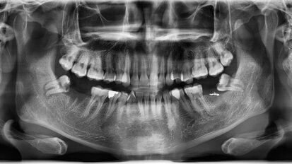 Well-known age assessment using third molars is not scientifically backed, says study