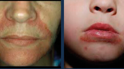 Dermatite periorale? Un’arma terapeutica in più con i trattamenti integrati