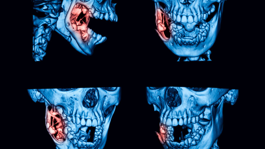 Các nang sừng gây ra mùi không được chẩn đoán trong thời gian quá dài