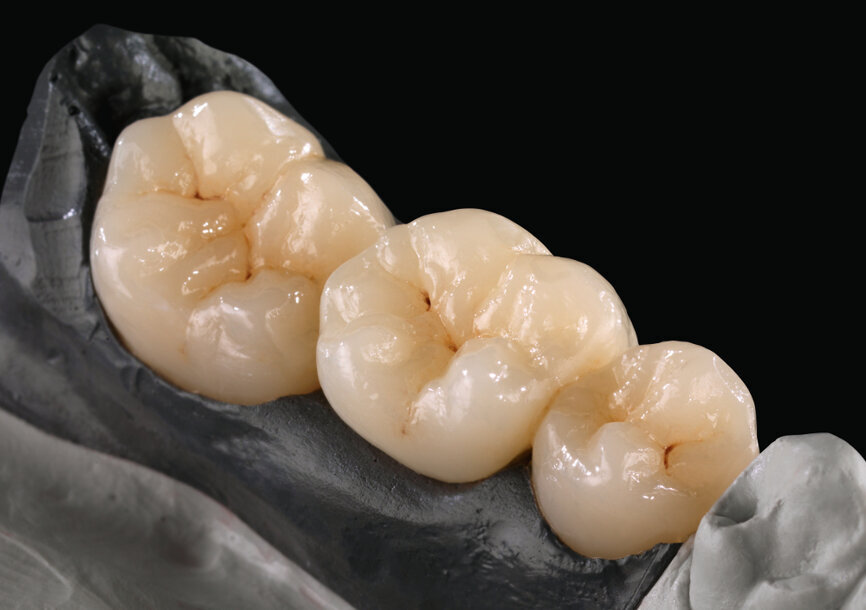 Zolid FX Preshade kam 2015 auf den Markt. Abgebildet ist eine Restauration von Brücke 35–37 monolithisch, bemalt. © Amann Girrbach