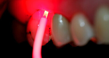 Antibakterielle Photodynamische Therapie – Standpunkt und Ausblick