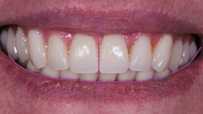 Restauri implantoprotesici: la sfida di creare un sorriso esteticamente gradevole  in un paziente edentulo