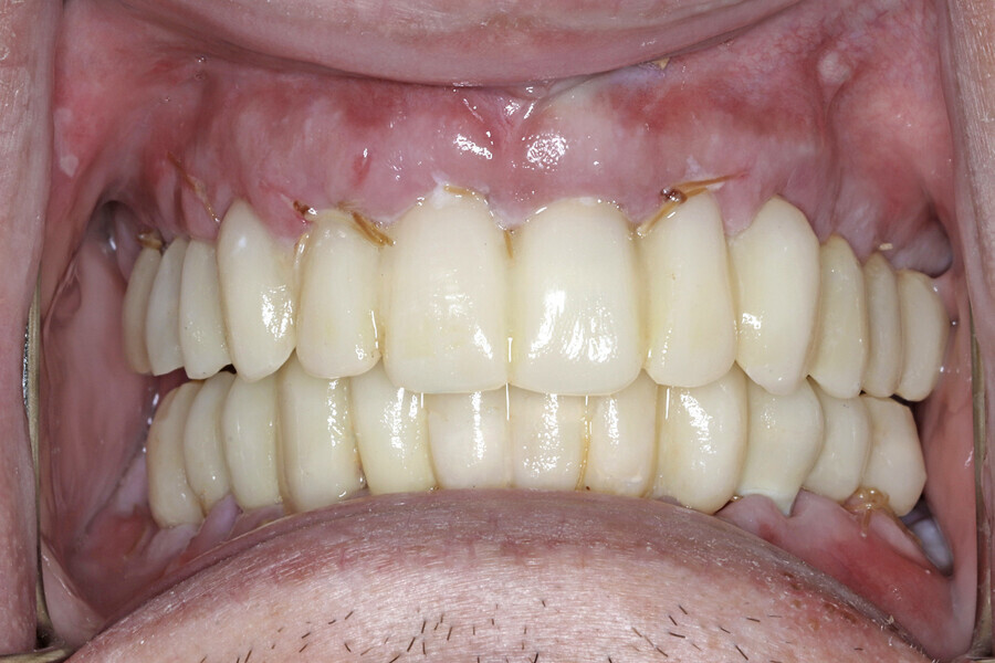 Fig. 14e: Retracted view of the provisional restorations (a) fabricated with C2F small hole technology (b). Two-week post-op smile (c). Two-week post-op panoramic radiograph and intra-oral photograph showing excellent healing (d & e).