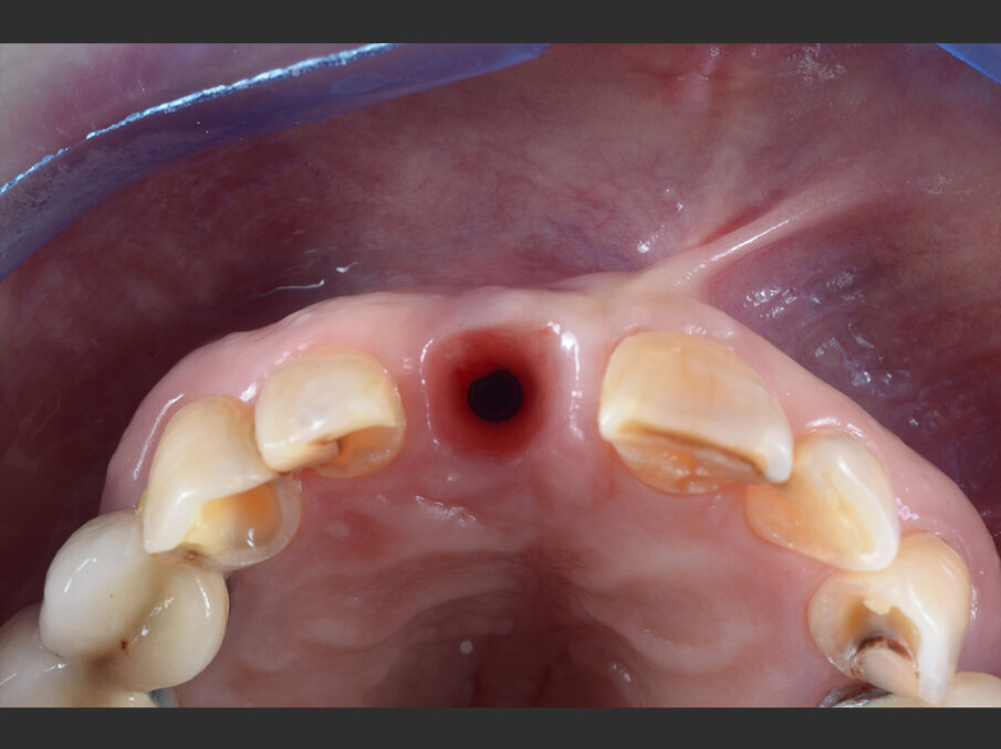Fig. 7 - Valutazione clinica a 3 mesi dal posizionamento: l’impianto è ben integrato ed i tessuti molli sono stabili.