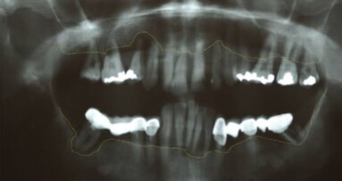 Riabilitazione bimascellare su impianti in paziente con iperplasia mascellare: step-to-step