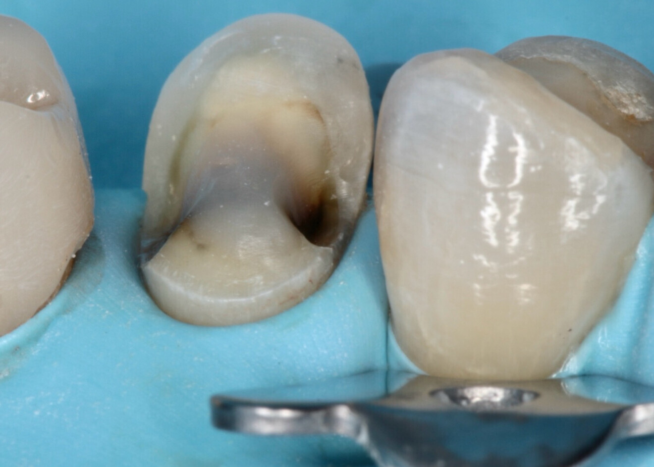 Fig. 1 : Préparation cavitaire optimisée pour restaurations partielles collées en céramique.