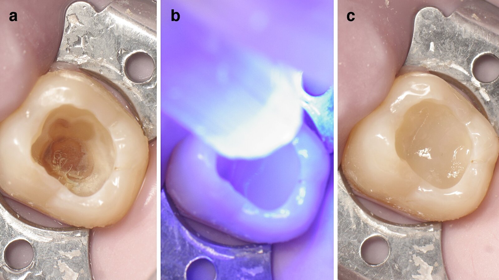Restauración clase I con composite termoviscoso