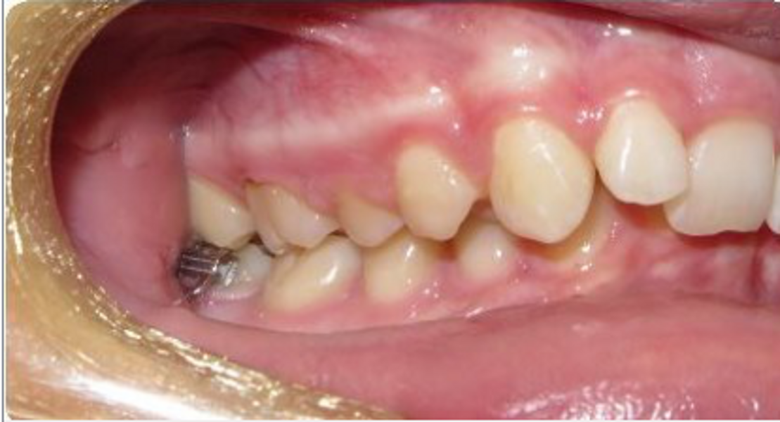 Fig. 16: Class II set-up for sequential distalisation.