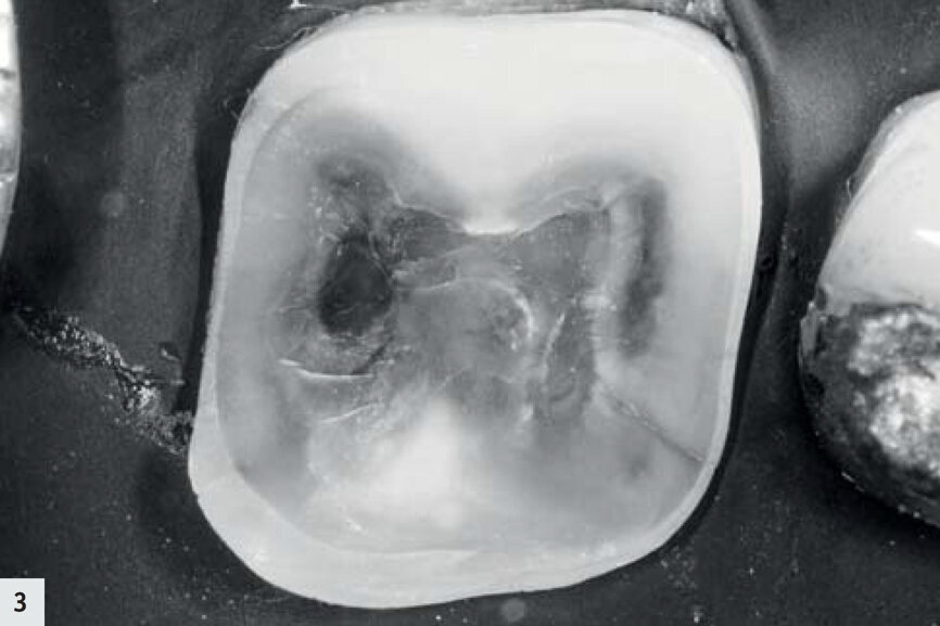 Fig. 3 : Même dent, nettoyée par air-abrasion. 