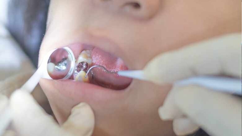 Für den Erhalt von Amalgam – Stellungnahme von BZÄK und KZBV