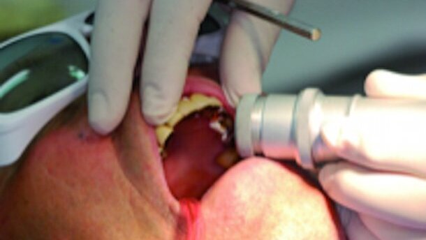 Le laser en dentisterie : passé, présent et futur