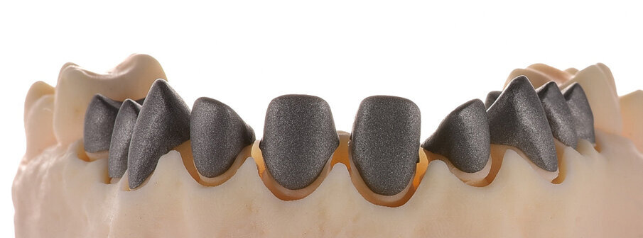 Fig. 4: Printed model with SLM metal copings