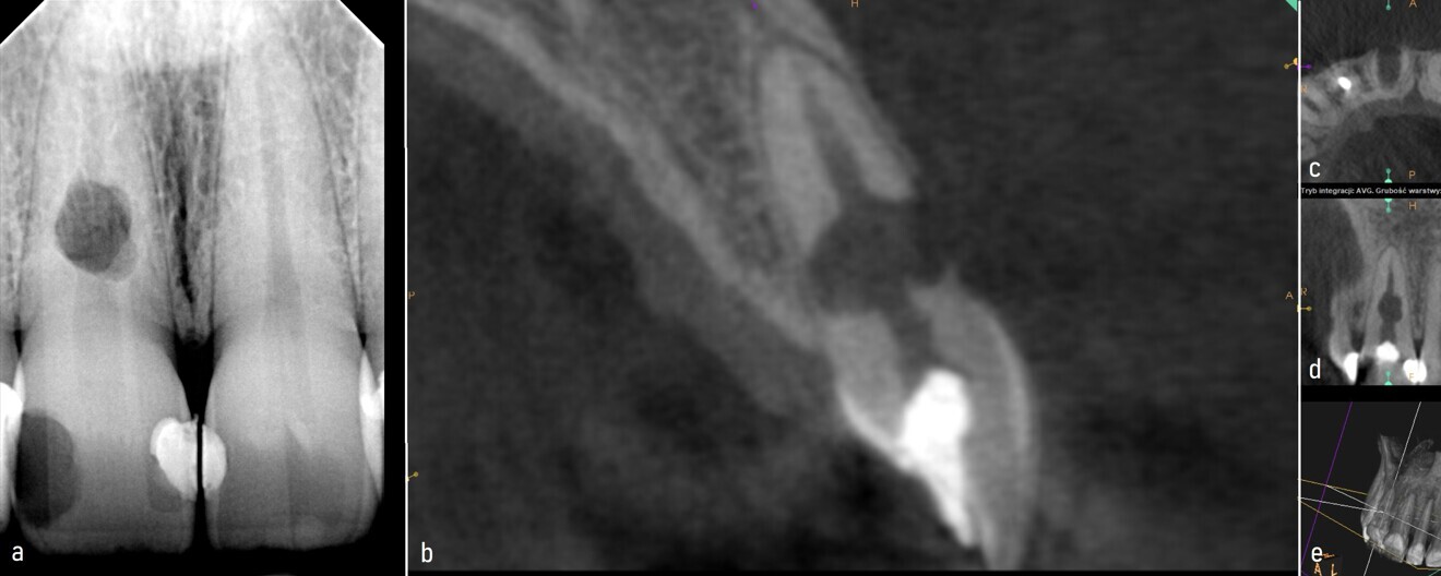 Fig. 8c: Radiograph (a) and CBCT scan (b–e) taken before the treatment, showing the root perforation and perforation of the cortical bone.