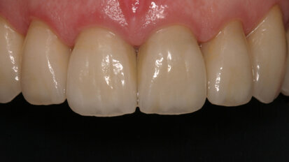 Using provisional restorations in complex restorative cases Using provisional restorations in complex restorative cases