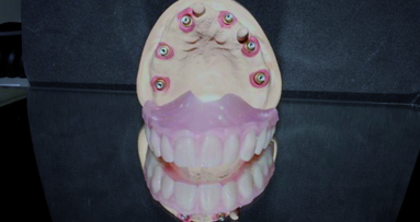 An implant-supported prosthetic restoration concept for edentulous atrophied maxillae