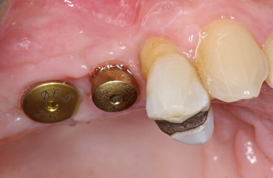 Fig. 12: Healing Abutments EV placed at three months after initial surgery.