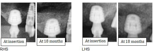 Fig. 11b_Confronto della qualità ossea prima e dopo 18 mesi degli impianti ultra-short inseriti a livello del mascellare superiore destro e sinistro.