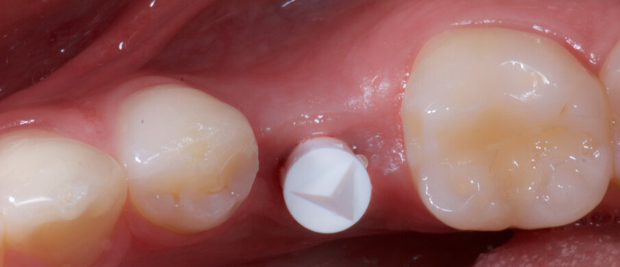 Fig. 5b_Gli scan body avvitati.