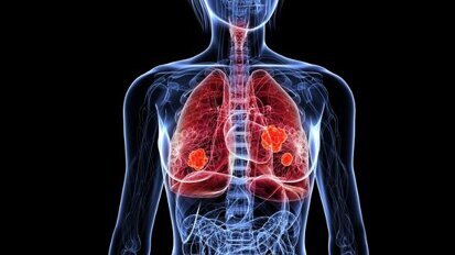 Krebsdiagnose durch Atemtest Krebsdiagnose durch Atemtest