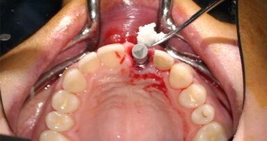 Gestione dei tessuti molli peri-implantari in pazienti con sorriso gengivale