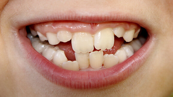 Frühkindlicher Stress führt zu schiefem Biss