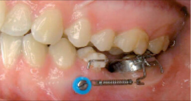 Miniimplantáty: ústřední bod ortodontické praxe. Část I. ze VI: Základy a historie kotvení – výběr šroubů