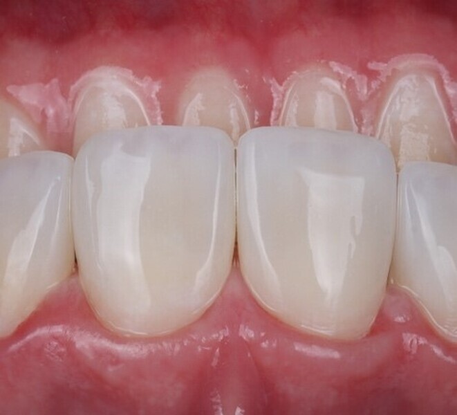 Fig. 3m: Close up view on  the natural anatomical contour achieved for life like aesthetics.