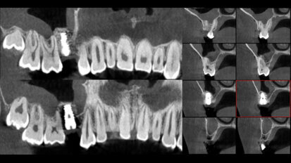 Augmentace sinu a současné zavedení implantátu za použití jednofázové sendvičové techniky