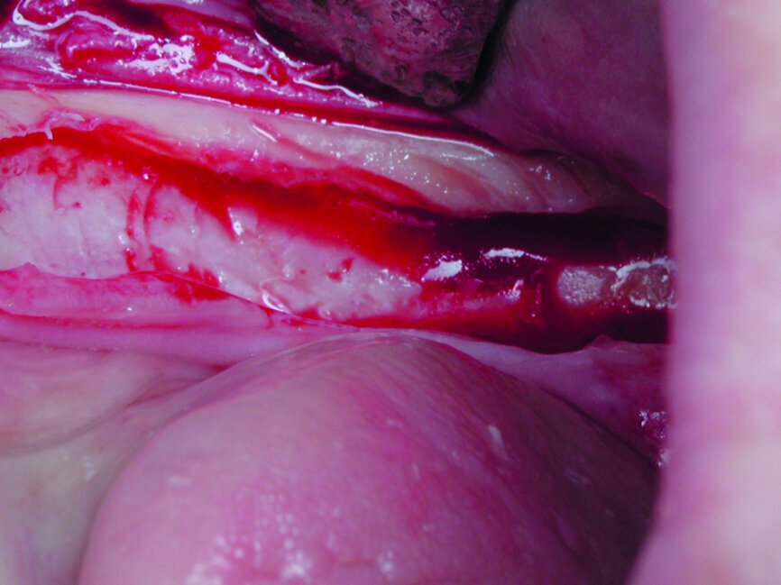 Cas 2 Indication pour une implantation bi-maxillaire. À la mandibule, préparation du lit receveur d’un implant à plaque, avec sa logette latérale vestibulaire  