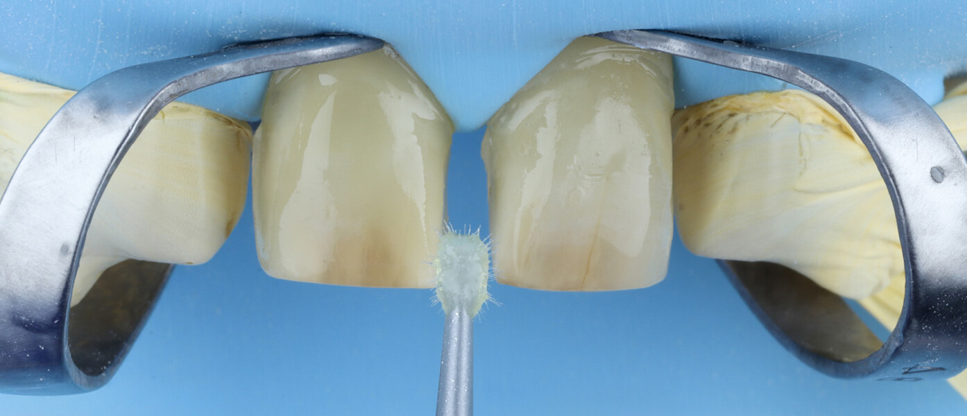 Fig. 17: Application of the tooth primer to the prepared surfaces.