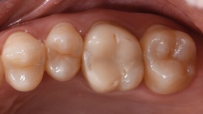 A biomimetic approach to restoration after endodontic treatment