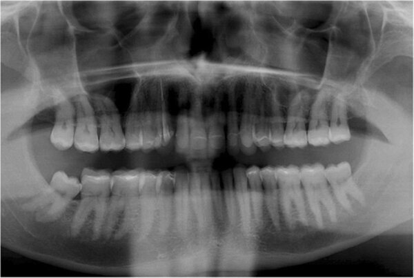 Fig. 15. Imagen panorámica final.