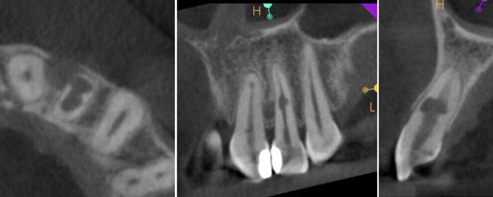 Case 1—Figs. 1a–c: CBCT scan taken before the treatment. Axial plane showing the root wall perforation (a). Coronal plane showing the lesion (b). Sagittal plane showing the perforation of the cortical bone (c).