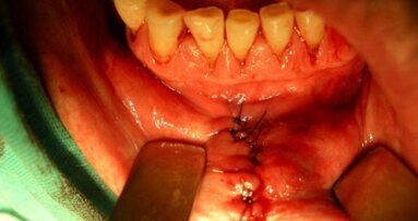 Wczesna diagnostyka i leczenie raka wargi dolnej – opis przypadku