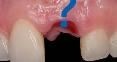 Sposoby zaopatrywania zębodołu poekstrakcyjnego