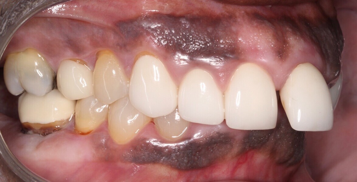 Fig. 9: Right lateral view of the teeth in maximum intercuspation.