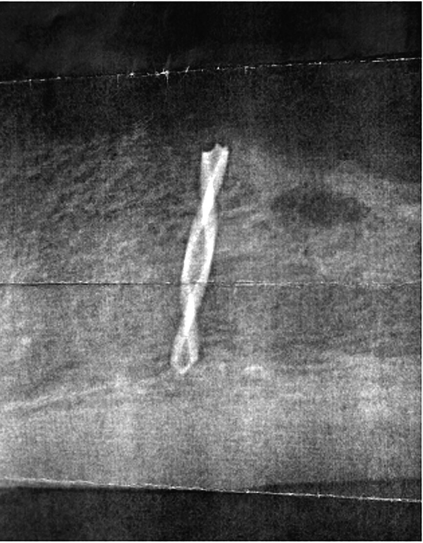 Fig. 6: Reveals the broken pilot drill ‘in the bone’.