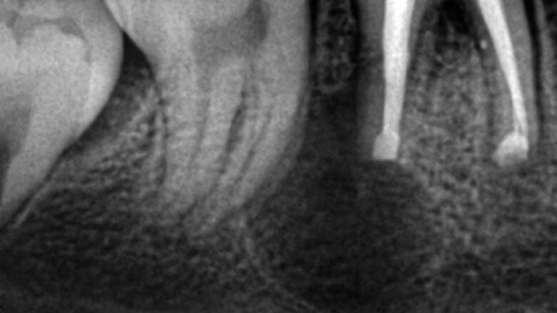 Figura 6. Control al mes, donde se evidencia inicio de cicatrización y reparación de la reabsorción radicular externa.