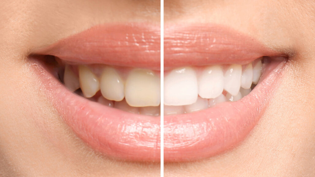 Beyond cosmetics to care: Biocompatible tooth whitening