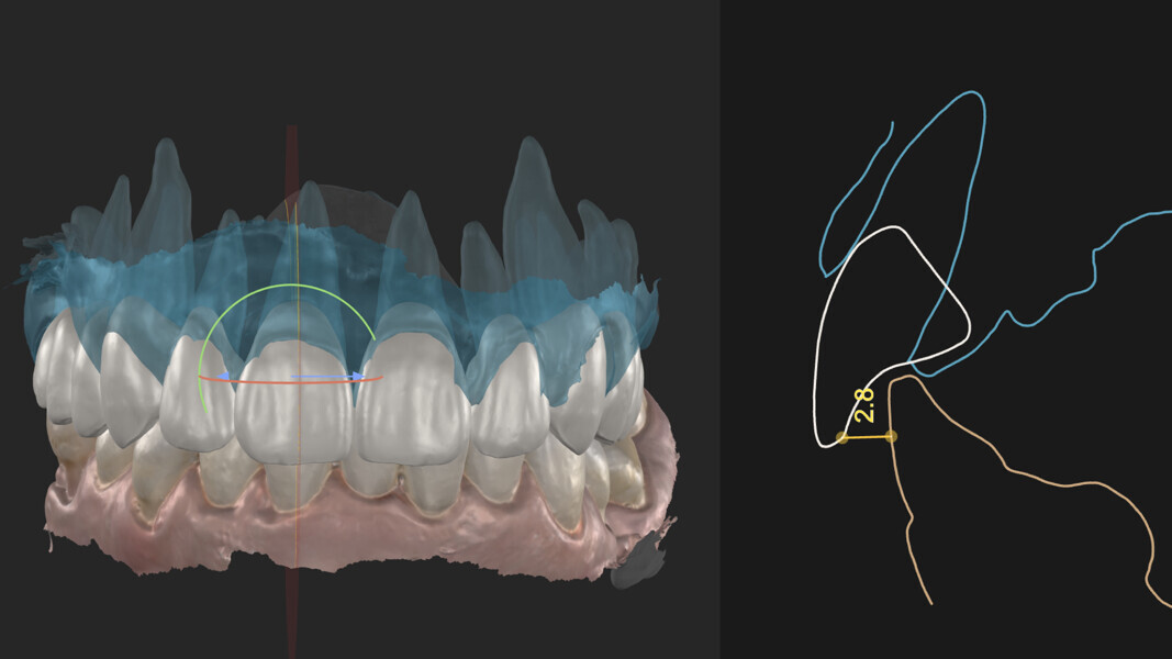Fig. 10: Compensating for occlusal disharmony.