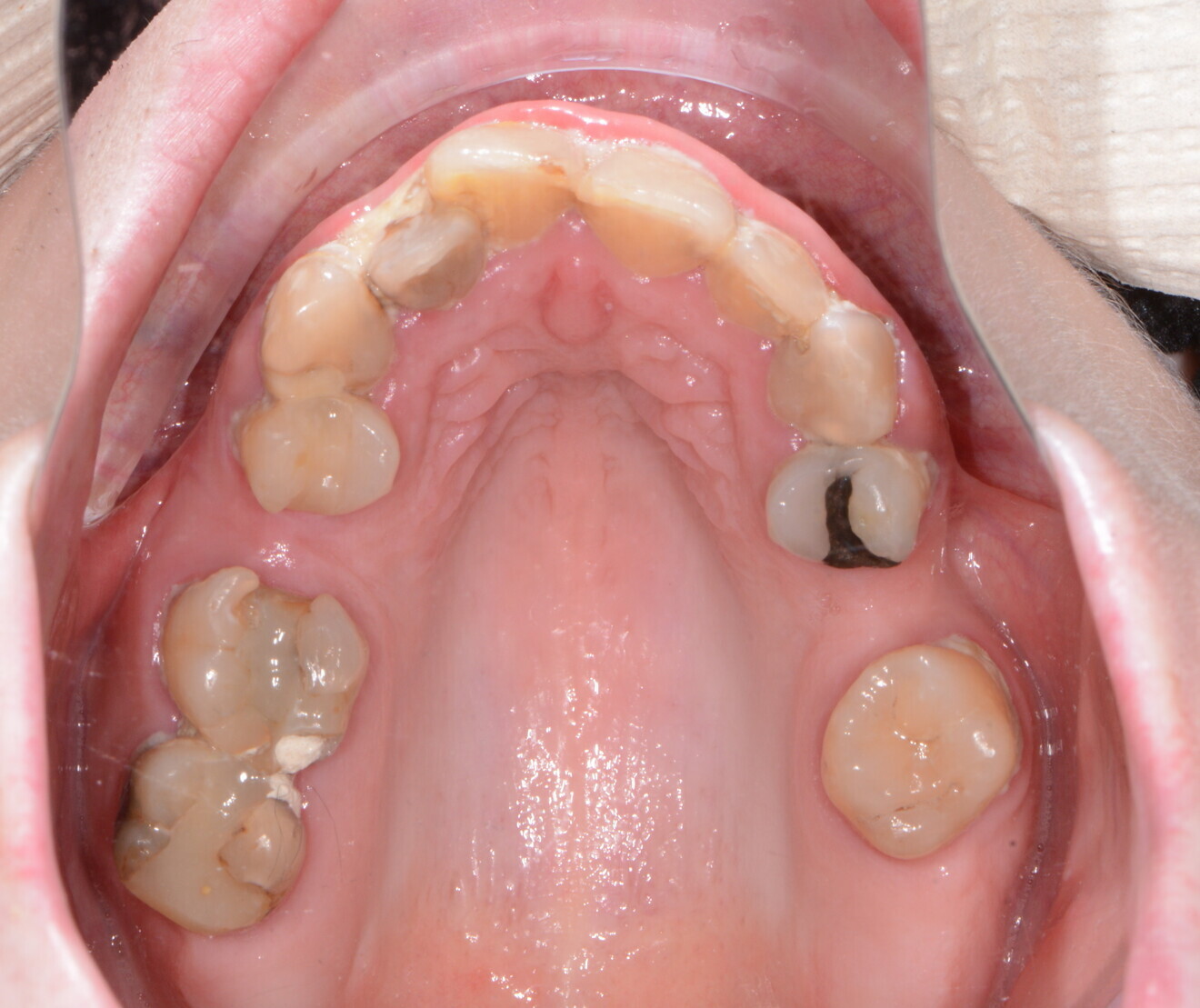 Fig. 2: Pre-op occlusal view.