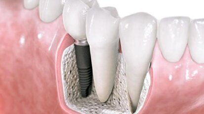 Implanty – estetyczne, bezpieczne i wcale nie takie drogie