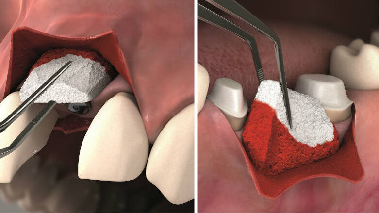 Geistlich Fibro-Gide®: la scelta dei clinici