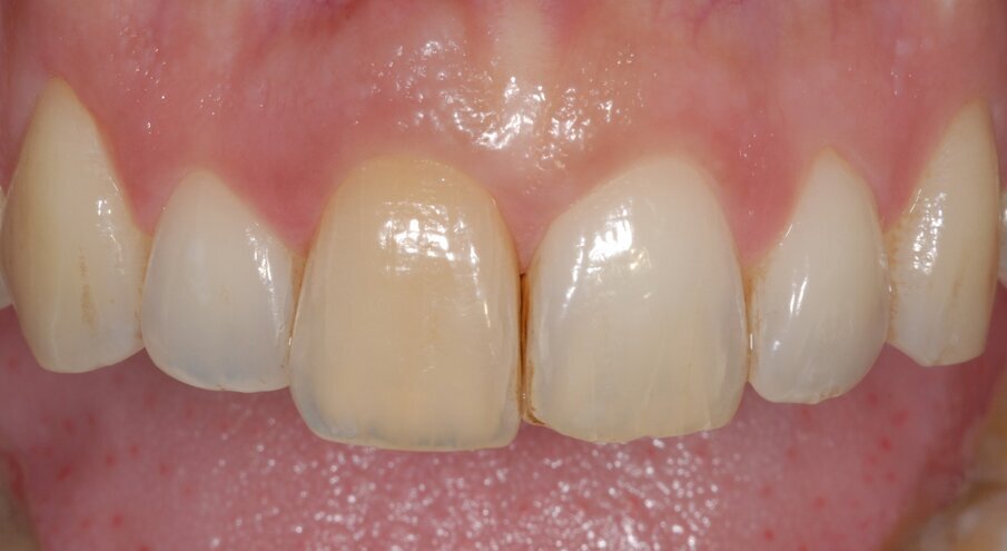 Fig. 1 - L’incisivo centrale di destra appare di colore più scuro e mobile.