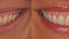 Dvofazno estetsko produženje kliničke krunice zuba